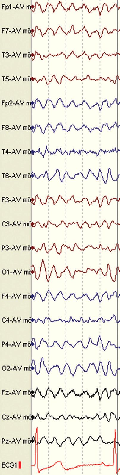 posterior dominant activity, log absolute power and relative power of delta (0.