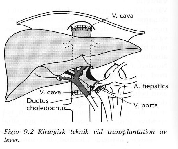 1-2/år pga AFL 5-års överlevnad > 90% Multidisciplinär rond beslutar Tx-kir/-koordinatorer/-anestesi, adult- och barnhepatologi Fortfarande mycket