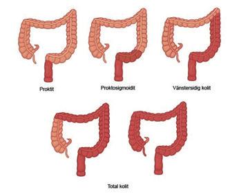 En del personer har inte vetat om att de är sjuka förrän stoppet är ett faktum. Hos en del håller sig inflammationen i ändtarmen för alltid men hos andra drabbas hela tjocktarmen.