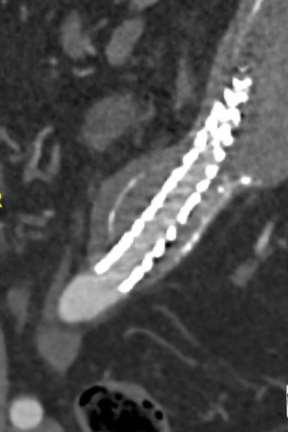 Figur 23: Efter behandling med distal förlängning med Ovation ix iliaca-stentgraft Behandlingsalternativ vid aneurysmförstoring För patienter hos vilka aneurysmförstoring föreligger och endoläckage