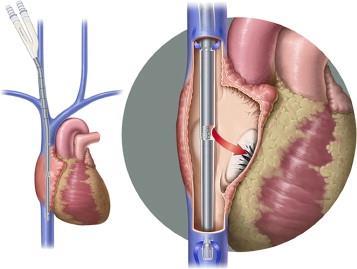 V-V ECMO Dual