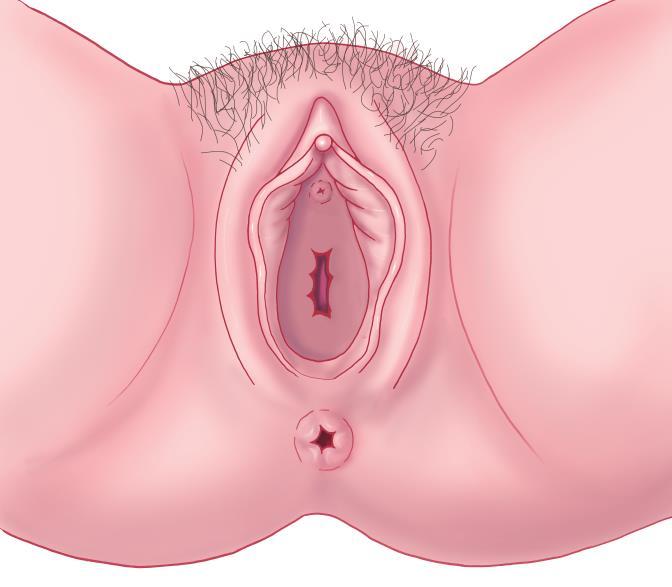 KAPITEL 4 Epidemiologi och riskfaktorer 4.1 Epidemiologi Vulvacancer innefattar cancer i det yttre kvinnliga könsorganet inkluderande mons pubis, labiae, klitoris, Bartholinis körtlar samt perineum.