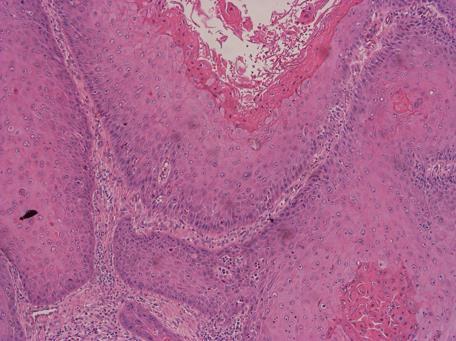 Figur 3. Positiv p16-färgning i skivepitel kan i vulva vara relativt begränsad till de basala delarna av epitelet.