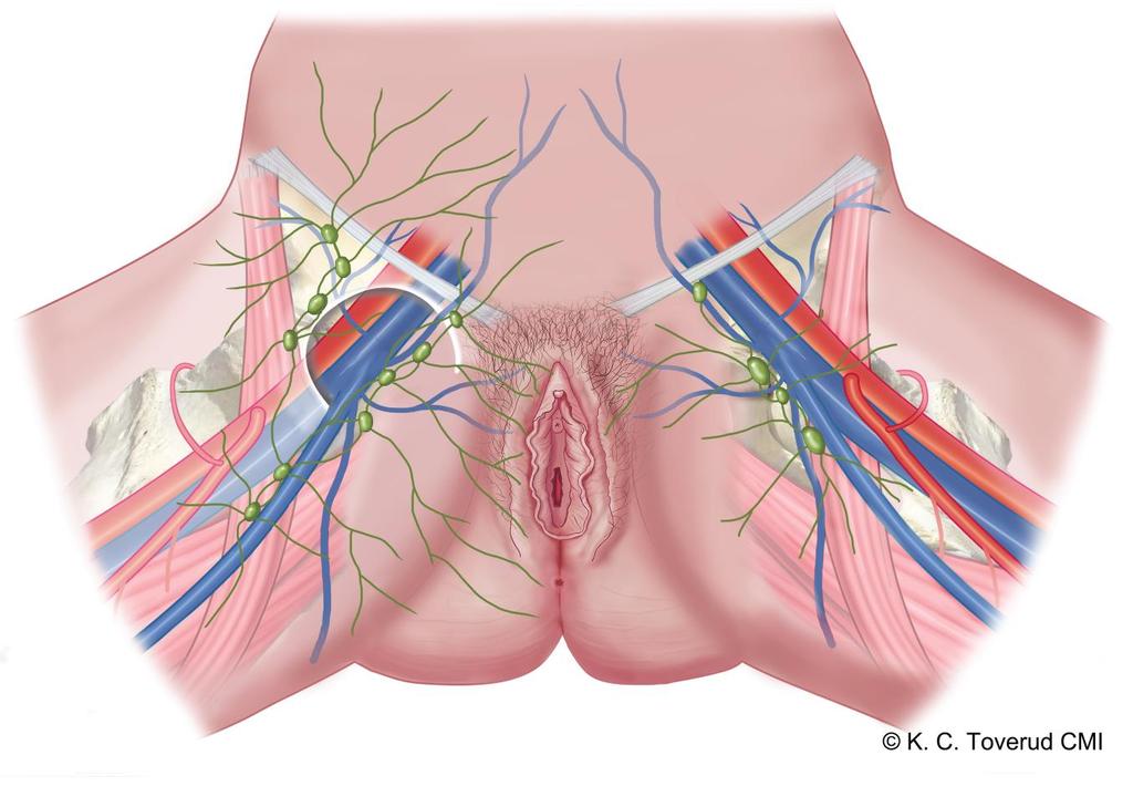 11.2.1.1 Anatomi och begränsningar av operationsfältet Skikt Anatomiska begränsningar Superficiellt skikt = trigonum femoralis Anterior Posterior Lateral Medial Kaudal Kranial Scarpas fascia Fascia