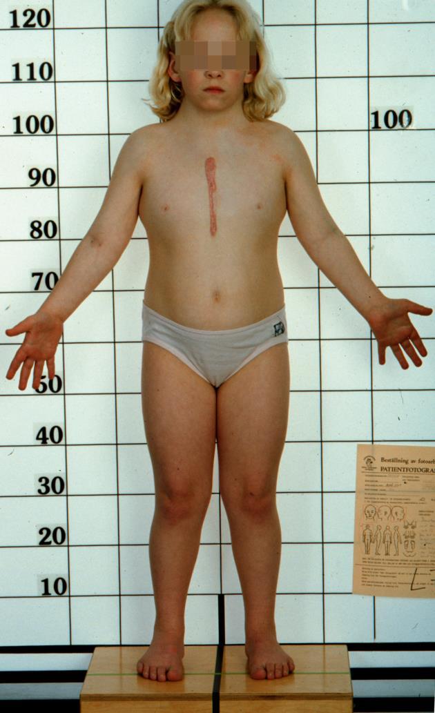 Turners syndrom: Genetik: Medfödd avsaknad av eller defekt på X-kromosomen i alla eller vissa celler.