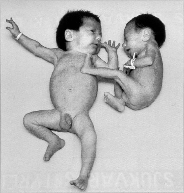 Birth size: an indirect marker for intrauterine