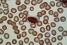 Juvenil neuronal ceroidlipofuscinos, JNCL Diagnos fferg visar tidigt avsaknad av aktivitet Genanalys påvisar sjukdom i 80% av fallen Mikroskopi av
