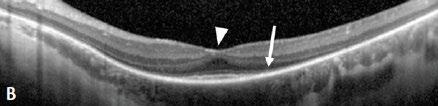 OCT visar Retinitis Pigmentosa, RP Avsaknad av IS/OS