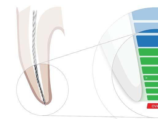 Instruktioner steg för steg 6.10 Identifiera arbetslängden 6.10.1 Definition Den anatomiska terminologin definieras på följande vis: Nr.
