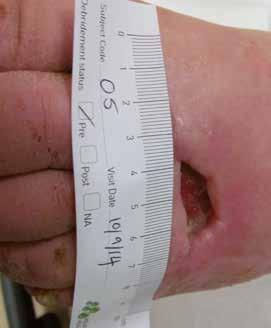 Baseline: Såryta: 0,55 cm 2 ; Djup: 0,4 cm Vecka 8: Såret helt läkt CASE 2 Exufiber användes för att behandla ett fyra månader gammalt