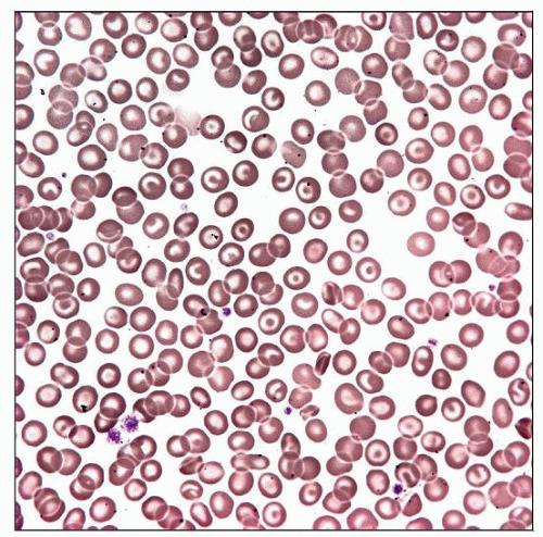 This peripheral blood smear from a Southeast Asian patient with thalassemia trait shows a fairly