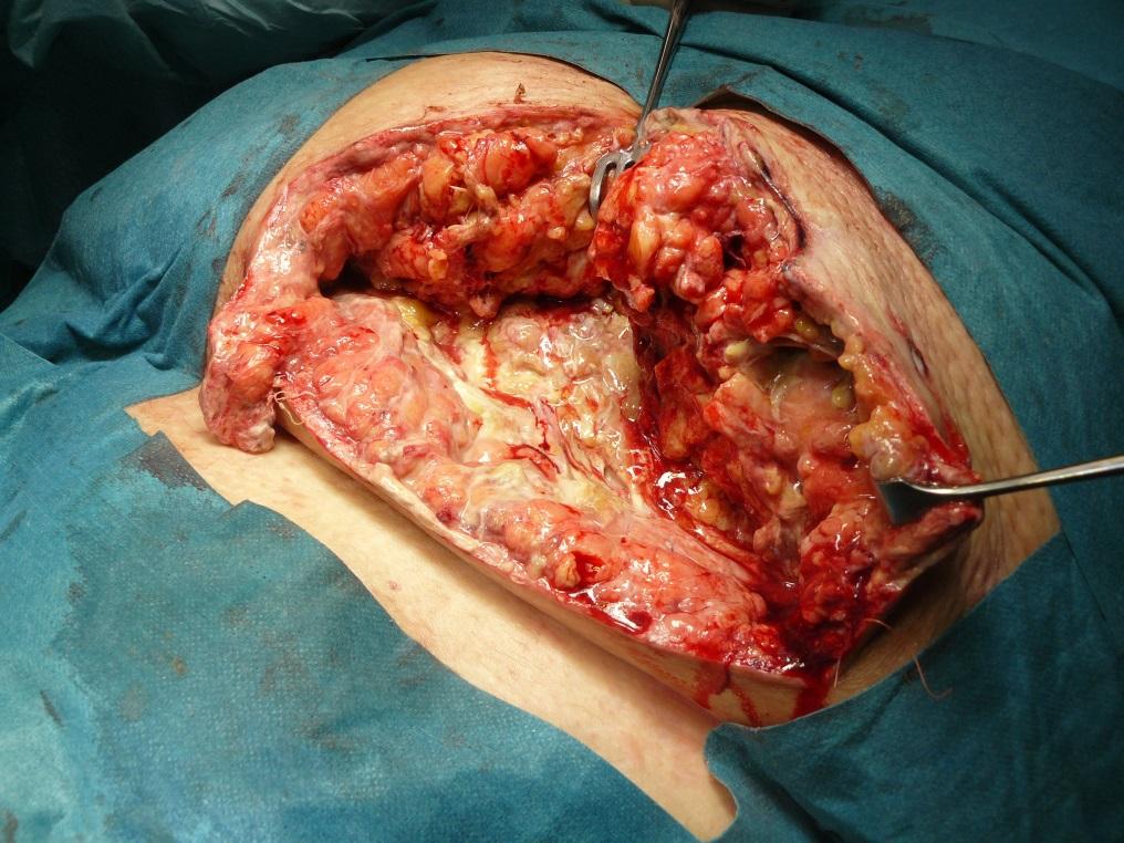 Postoperativ