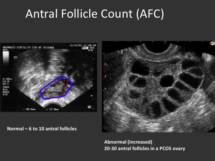 Ovarial reserv Storleken på poolen av oocyter i äggstockarna och deras AMH och AFC kvalitet vid vilken tidpunkt