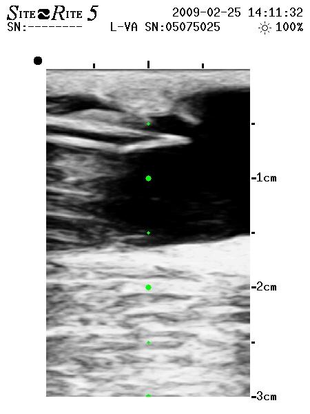 Punktion med ultraljud i vardagen 2018 Clinical Practice Guidelines of the European Society for Vascular Surgery: Diameter > 4 mm och QA >