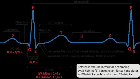 7. Jämför med tidigare EKG Det är fundamentalt att alltid jämföra den aktuella EKG-remsan med tidigare registreringar.