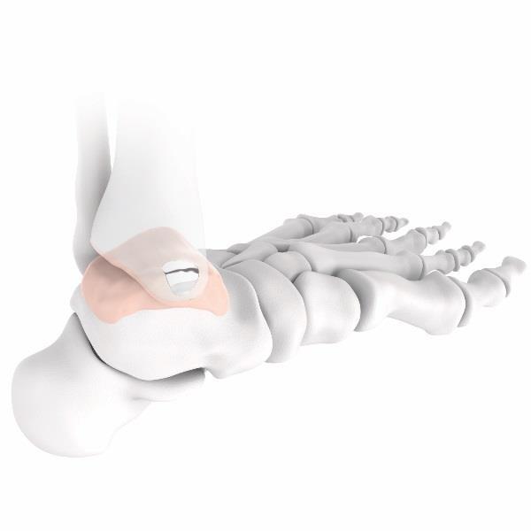 PRODUKT FÖR FOTLEDEN Vårt senaste implantat Episealer Talus Drivet av efterfrågan, utvecklad av vetenskap Episurf Medical har, baserat på de tekniska, prekliniska och kliniska erfarenheterna från