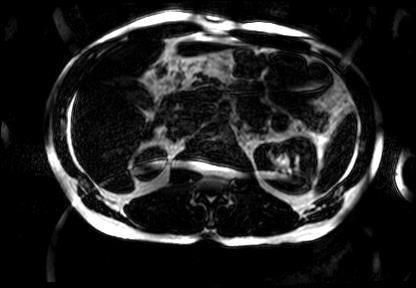 Figure 5. Fat image of kidneys and liver of a subject. The effect of failed SENSE reconstruction can be seen as residual aliasing taking the form of ghost images. 1.