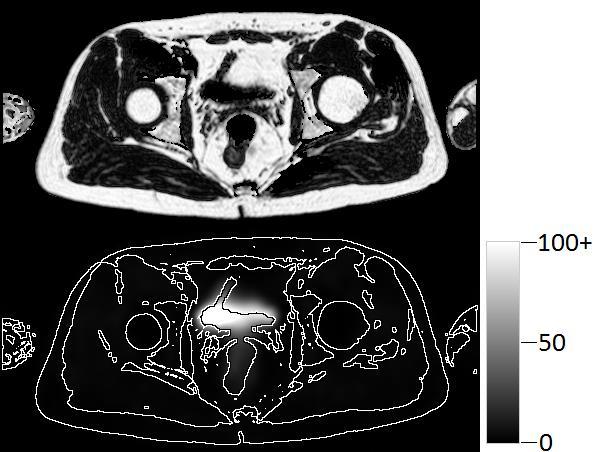 Figure 18. Images in the transverse plane from the groin sub-volume of subject 2. An example of where the parametric signal in the balder leaks into the surrounding adipose tissue.