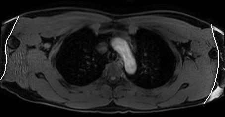 1.3.1 MRI artefacts Image artefacts are errors in images, there are several types of artefacts that can be present in MRI.