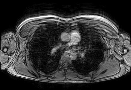Figure 3. Opposed phase image of the lungs of a subject. The subject was clearly breathing during the image acquisition, causing huge motion artefacts.