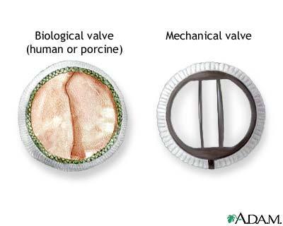 AVK antikoagulant behandling AVK hämmar vitamin K-beroende hepatisk gamma-carboxylering av glutamic syra i FII, VII, IX and X; hämma PC och PS; pga.