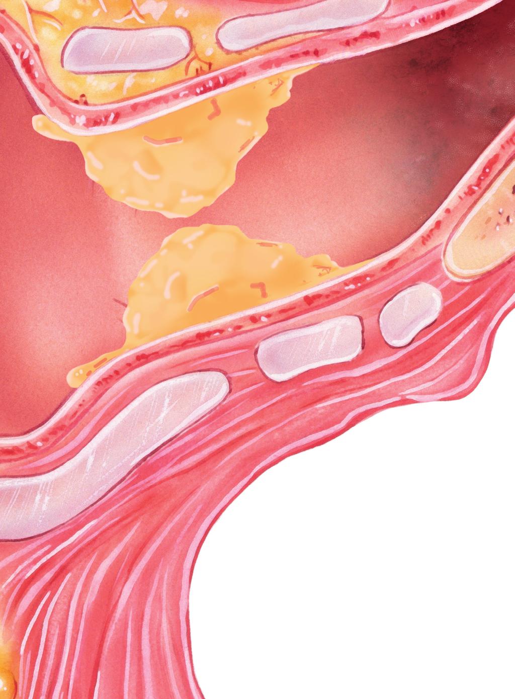 Ska jag ta bort öronvaxet? Öronvax bör inte avlägsnas från hörselgången, så länge det inte ger upphov till besvär. Om vax syns i ytterörat, kan du ta bort det med mjukt papper.