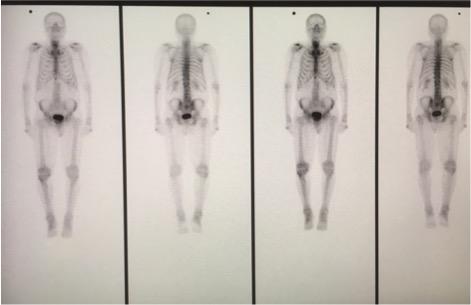 Figur 9: En standardsskelettscintigrafibild tagen under 18 minuter. Första och tredje bilden från vänster visar skelettet framifrån, andra och fjärde bilden visar skelettet bakifrån.