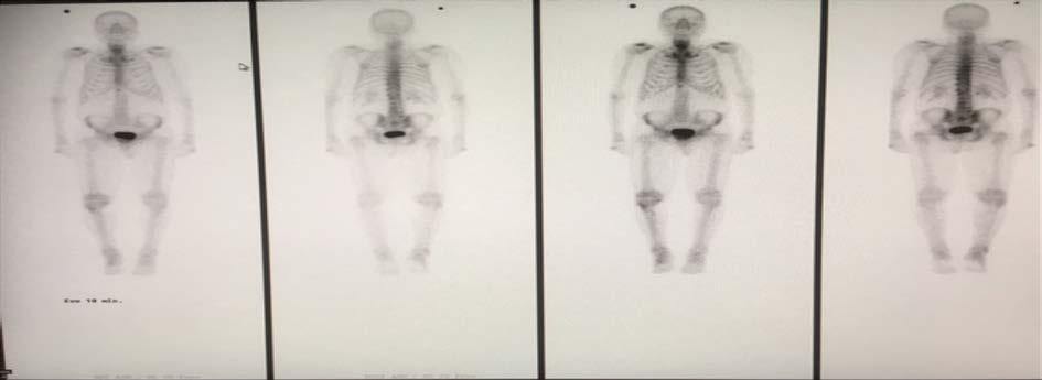 Figur 10: Rekonstruerad skelettscintigrafibild med Evolution for Bone TM tagen under 10 minuter.