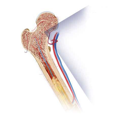 Sjukdomen multipelt myelom benmärgscancer Multipelt myelom är en cancersjukdom som uppstår i benmärgen. I benmärgen produceras en typ av vita blodkroppar, så kallade plasmaceller.