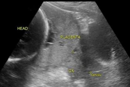 Definitioner: Placenta previa: Föreliggande placenta.