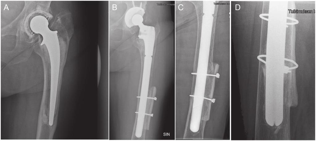 268 J. Mokka, et al. Table 3 The number of complications and the revision implant design (percentage in parenthesis).