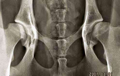 BVA/KC (British Veterinary Association/The Kennel Club) metod med poängskala där höfterna bedöms utifrån nio olika särdrag. Ju lägre poängen desto mindre HD-grad.