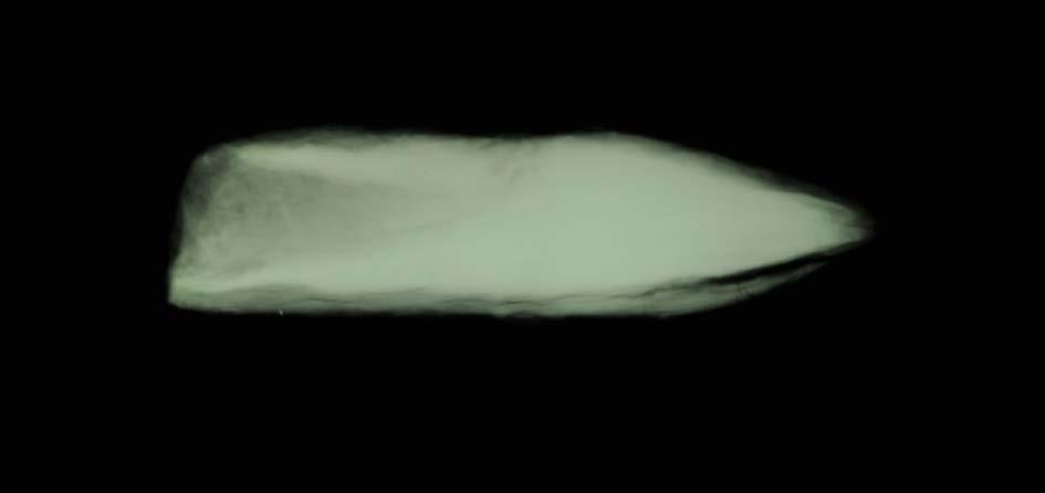 Spetsen röntgas för att studera dess status och bilden visar på ett spjälkat område samt holkens utseende och djup. Röntgenfotografi, pilen markerar spjälkningen i materialet.