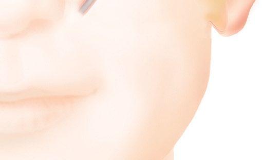 olevaan implantatet istutteeseen. under huden.