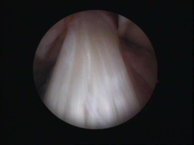 Vad är främre korsbandet? Främre korsbandet är ett ledband (ligament) som löper centralt inne i knäet mellan lårben och skenben. Bakom det främre korsbandet sitter det bakre korsbandet.