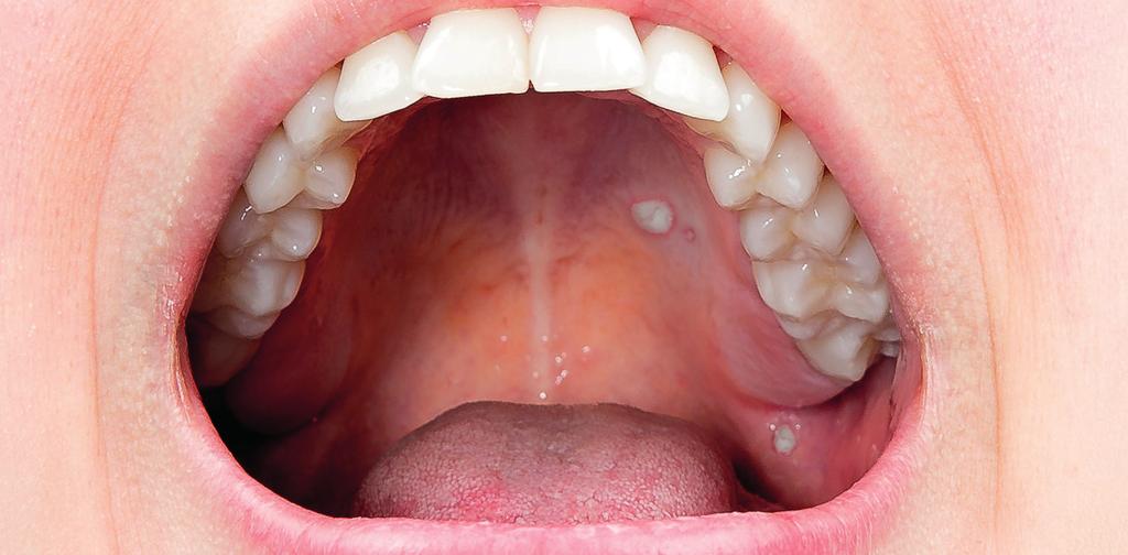 Aftös stomatit Aftös stomatit är ett sår i munhålans slemhinna som oftast gör ont. Det finns olika teorier om orsaken till aftösa sår i munnen. Nedan beskrivs några troliga orsaker.