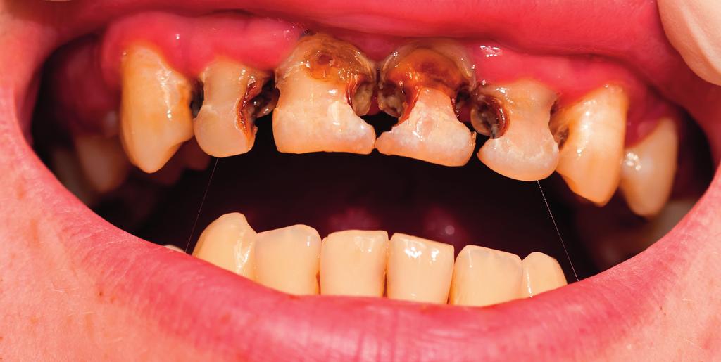 Karies Karies eller hål i tanden är en infektionssjukdom som orsakas av vissa bakterier i munhålan.