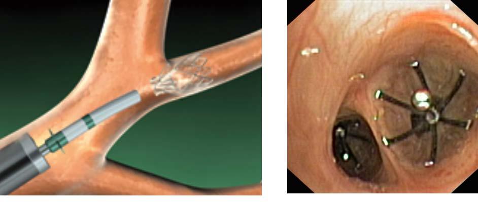 6. Endobronchial valves in severe emphysema Endobronchial lung volume reduction was introduced in 2002.
