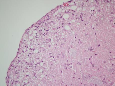 demyelination