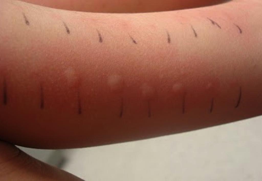 Allergiutredning Anamnes: Symptom vid exponering Pricktester IgE