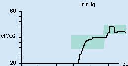 Drift Parameterfält för etco2-trenden Parameterfält för historik SVC-etCO2 SVC-historik SVC-AF SVC-Pinsp 01:15:10 10 -> 9 16 -> 17 A 311 Trenden för etco2 registreras under de senaste 30 minuterna.