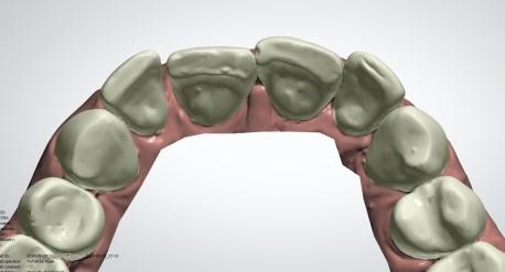 estetisk tandreglering med Clear Aligners.
