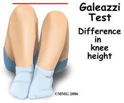 Benförkortning Galeazzi test : Testet är positivt när knäna är i olika höjder
