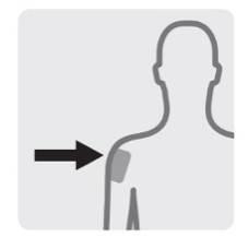 1 Välj kanyl Valet av kanyl bestäms av injektionsstället och patientens vikt.