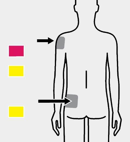 3 Injicera Injicera dosen Deltamuskeln Gluteusmuskeln Rosa koppling Gul koppling Gul koppling Injicera