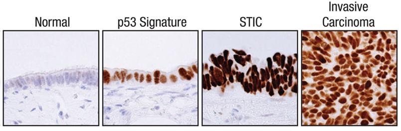 Riskfaktorer för OC: BRCA Mutationer i BRCA-generna starkaste riskfaktorn RRSO minskar