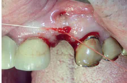Cyklokapron Tranexamsyra Brustabletter 1 gram recept 16 st 1 gram i 10 ml vatten.