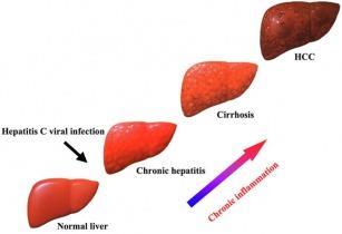 Fibrosstadier F 0 -F 4(cirros) Levercancer 1-5% per år