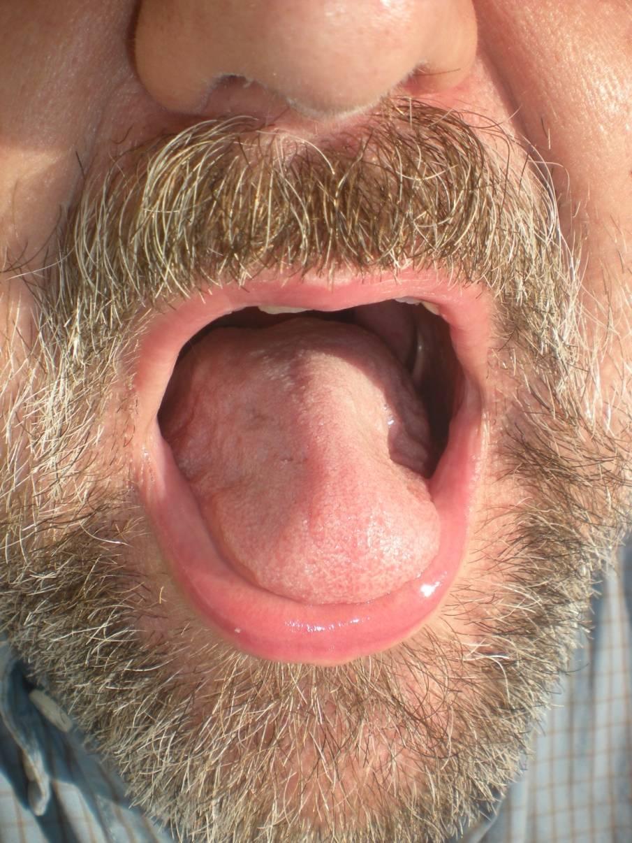 ! Ø Muskelatrofi följer ofta pga fördröjd diagnos Ø Oftast ses ingen
