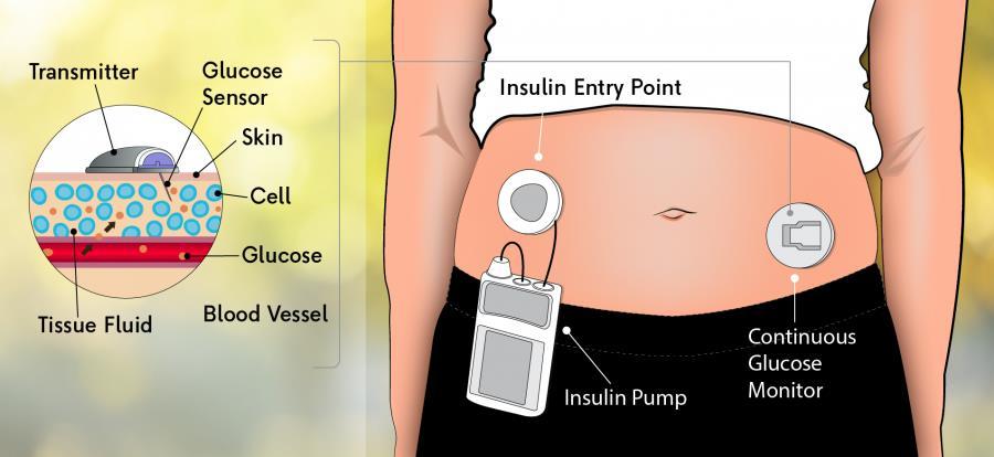 Larmar ej CSII continuous subcutaneous insulin infusion = Insulinpump SAP sensor augmented (förstärkt) pump. CGM-glukos avläses i pumpen SIP Sensorintegrerad pump.